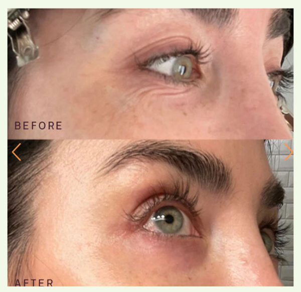 Dermaclara Ageless Beauty Bundle before after